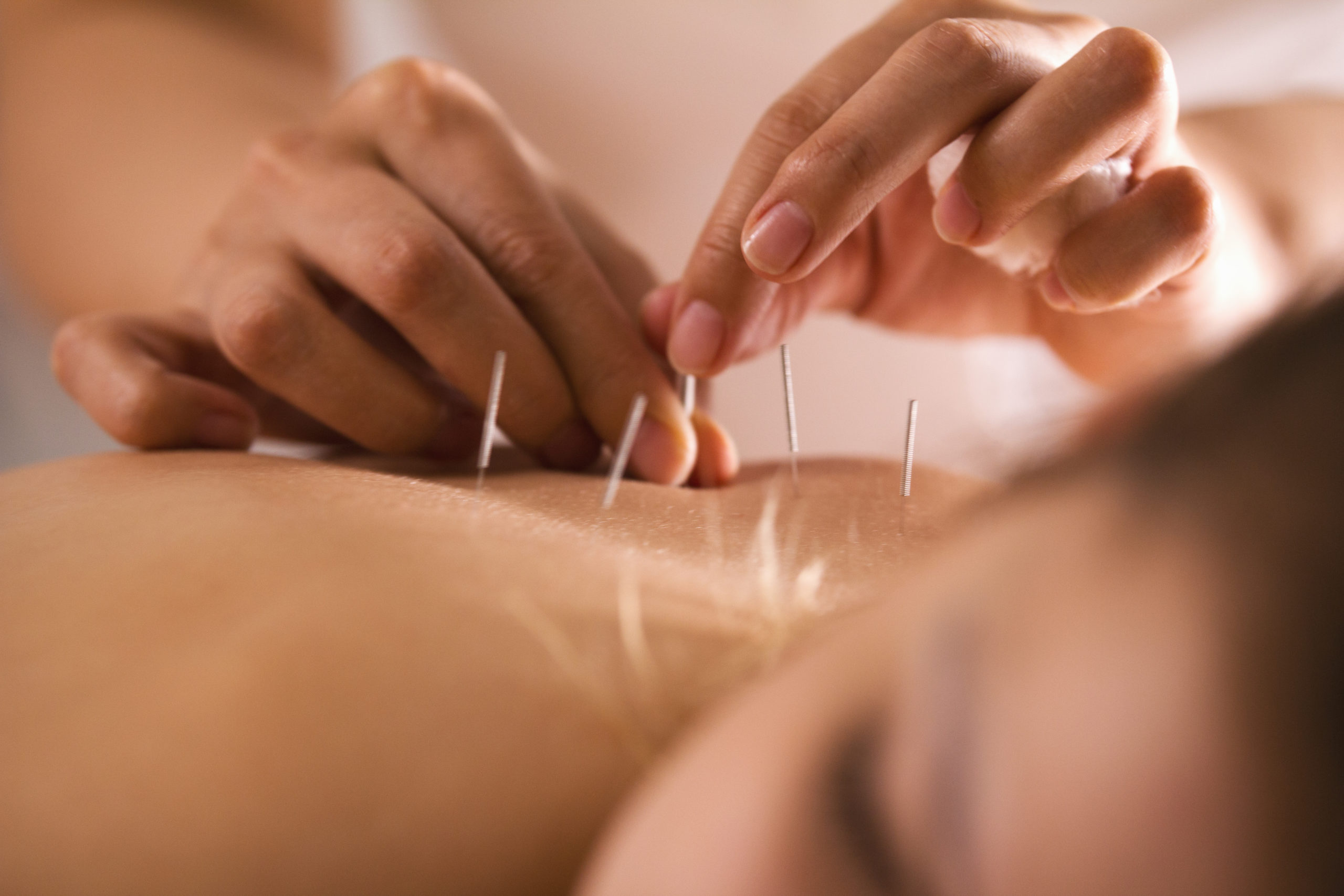 Dry Needling vs. Acupuncture: Which Is Right For You?
