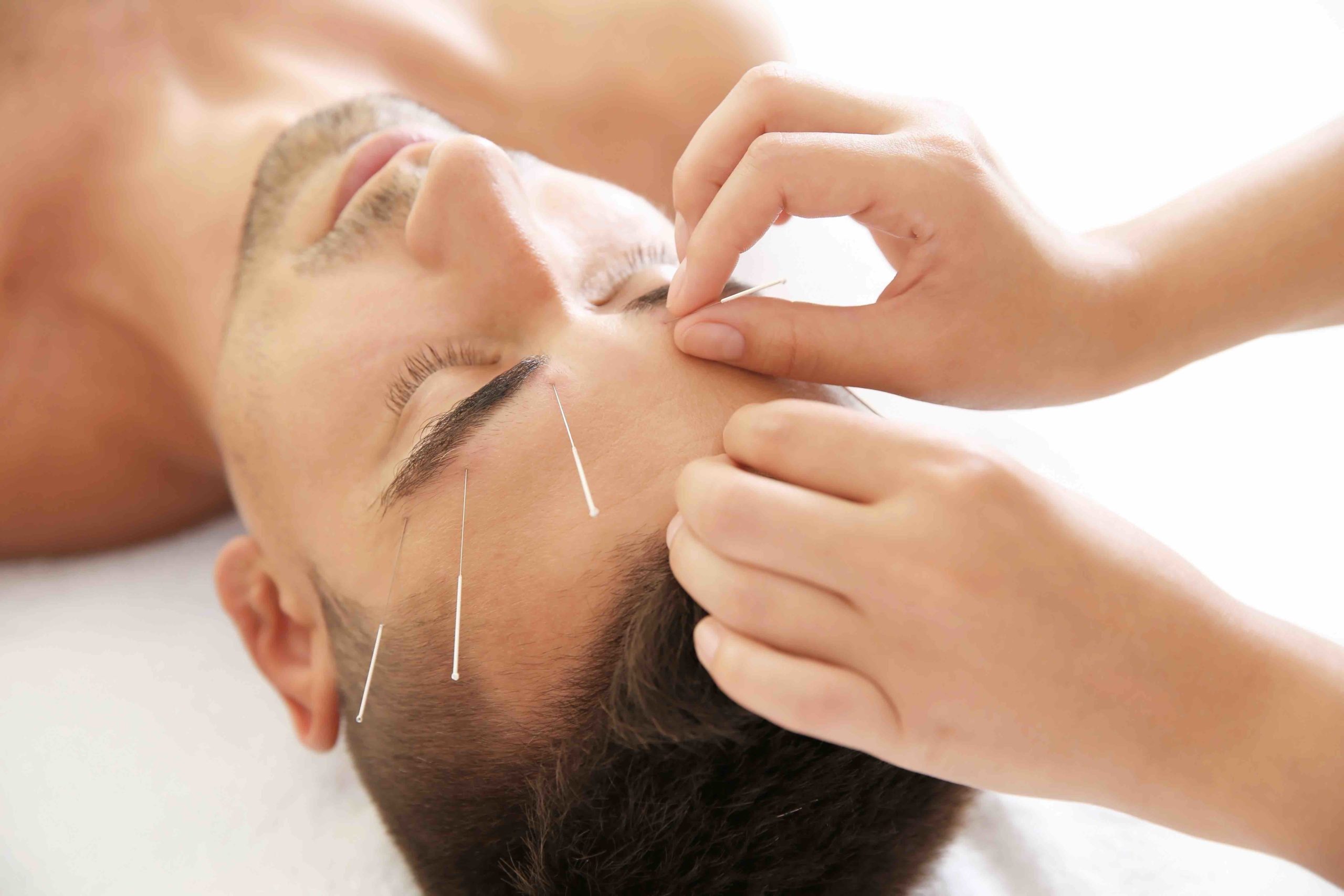 From Face Acupuncture to Fertility Acupuncture, Here’s Everything Acupuncture Can Do For You